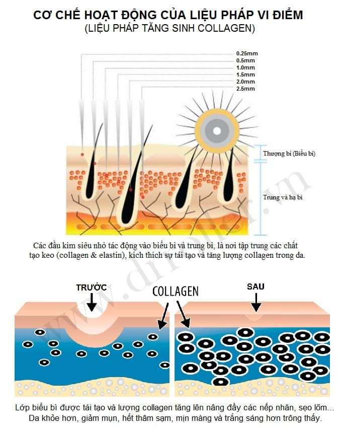 cơ chế lăn kim trị mụn