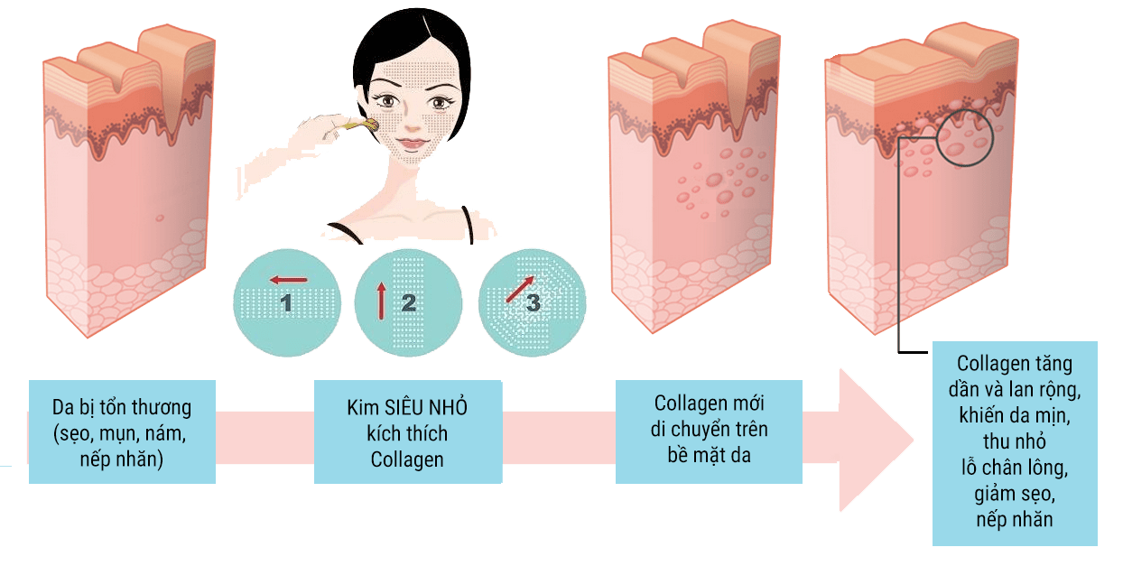 trị mụn bằng lăn kim