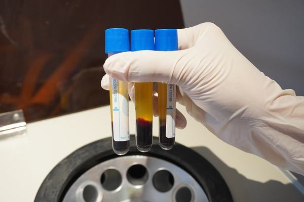 Cận cảnh huyết tương giàu tiểu cầu được áp dụng khi điều trị nám