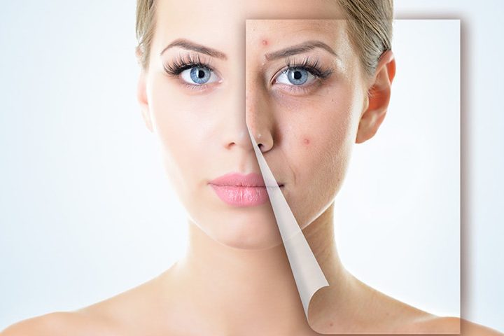 Trị nám da bằng công nghệ Mesotherapy