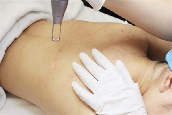 Có nên đến Spa trị mụn lưng và vết thâm hay không? - VIETSKIN